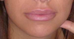 Levres-AR Botox Levres Apres