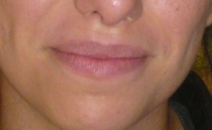 Levres-AV Botox Levres